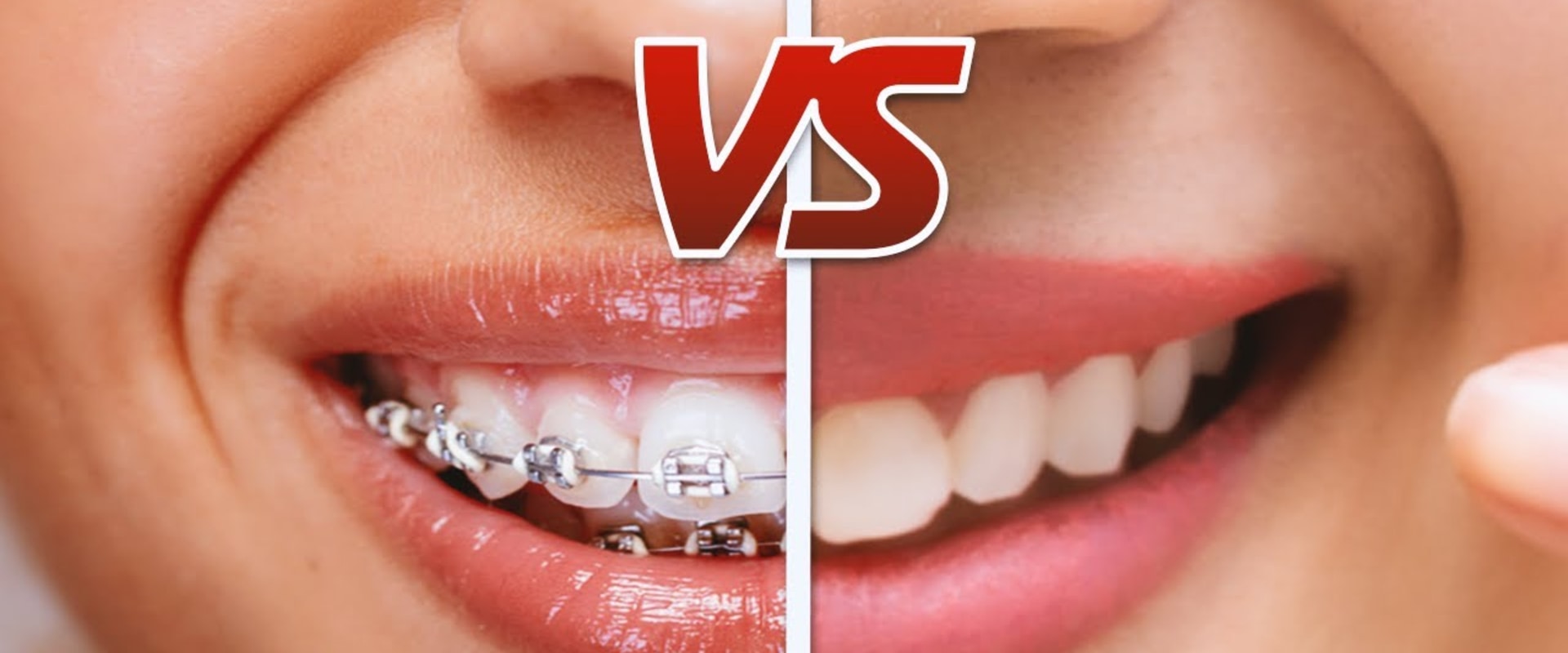 what-is-cheaper-braces-or-invisalign