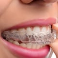 Braces vs Invisalign: Which is Better for Orthodontic Treatment?