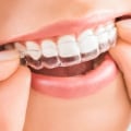 The Benefits of Invisalign: A Comprehensive Guide